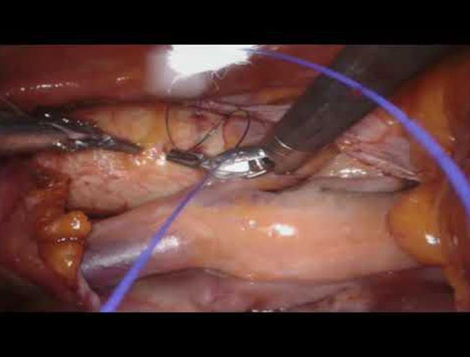 Robotic Excision of a Large Left Atrial Myxoma