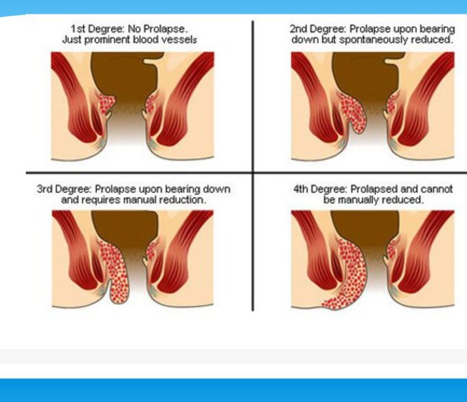 Degrees of Hemorrhoids