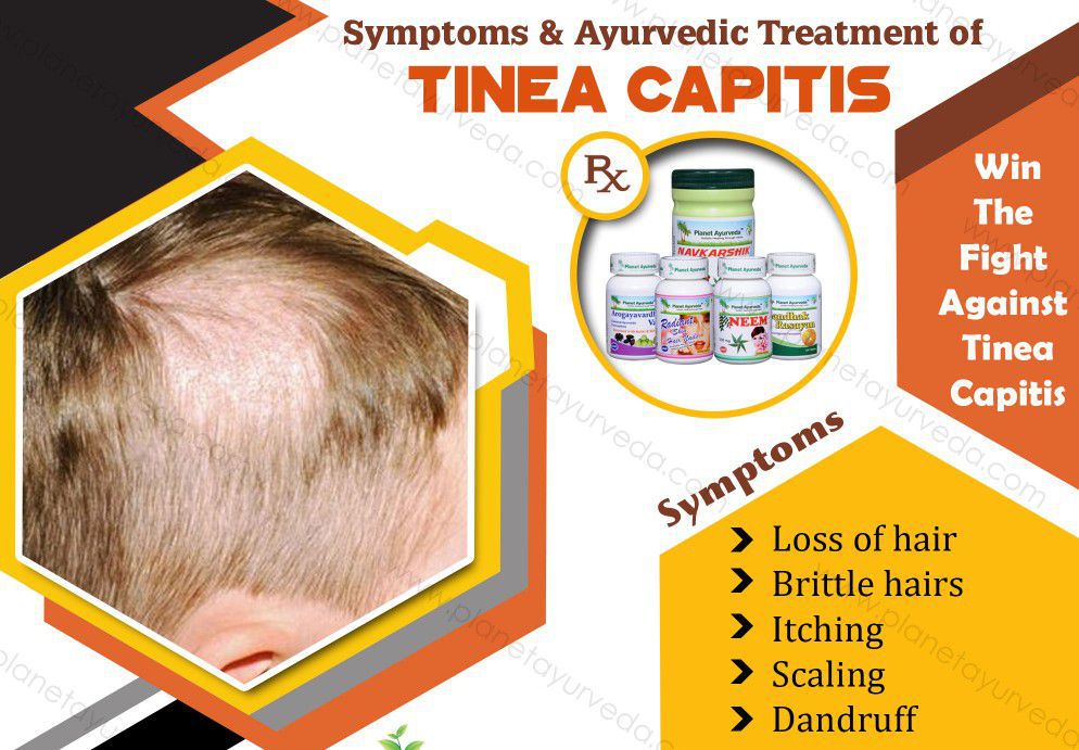 Tinea Capitis treatment MEDizzy