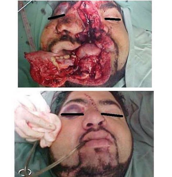 Face reconstruction after motorcycle accident