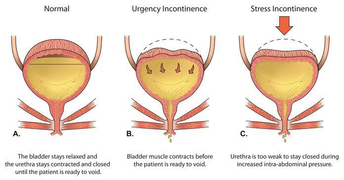 Urinary incontinence - MEDizzy