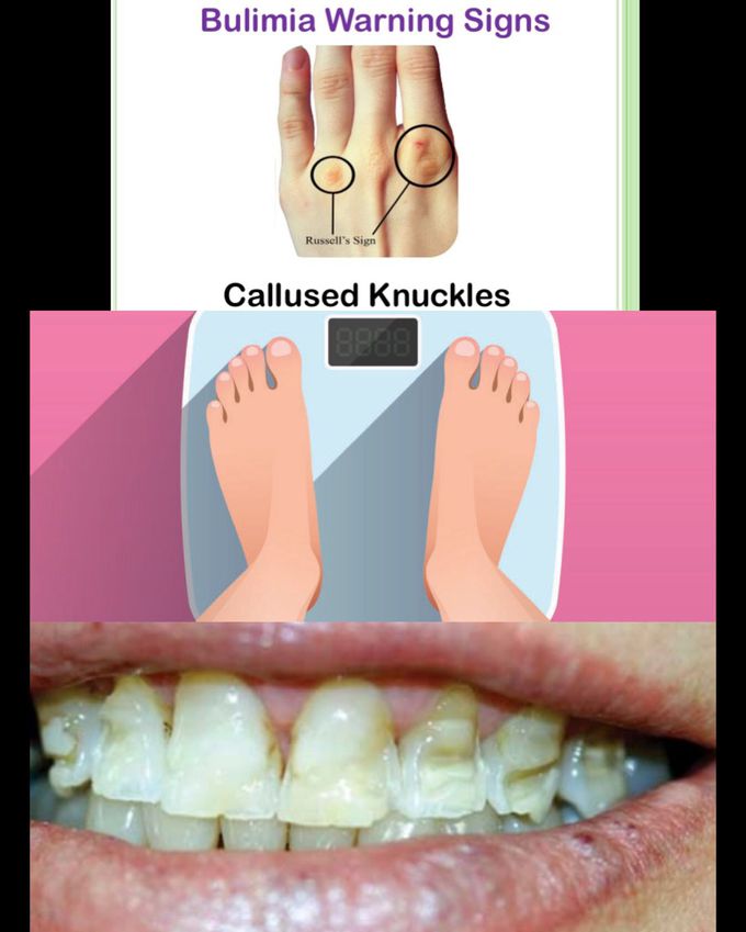 Bulimia Nervosa