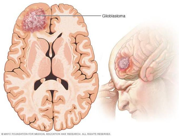 What is a brain tumor?