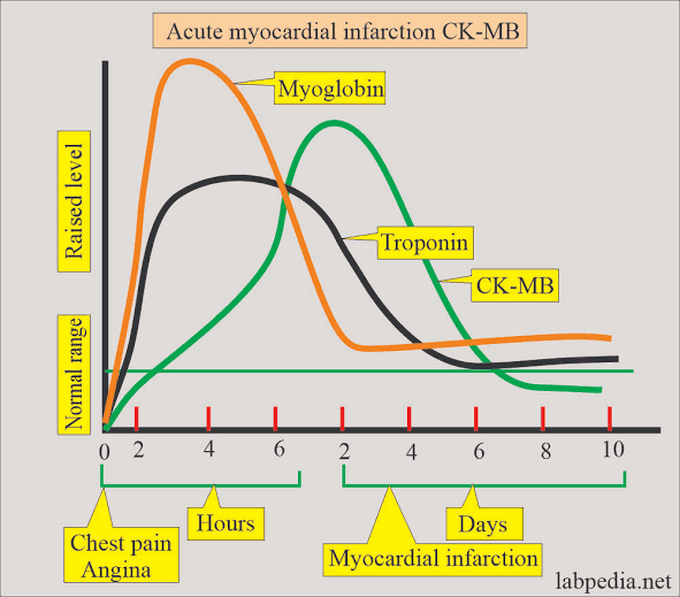 Acute Myocardial Infarction CK-MB