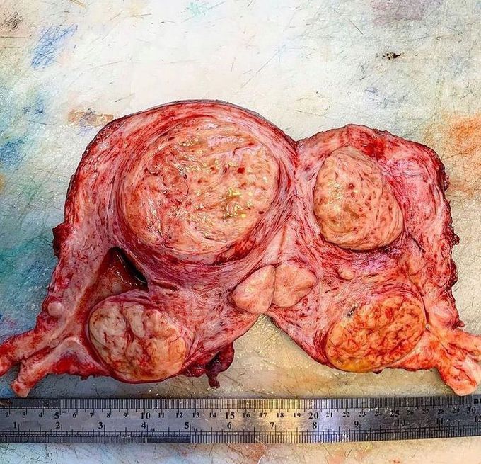 Uterine leiomyomas