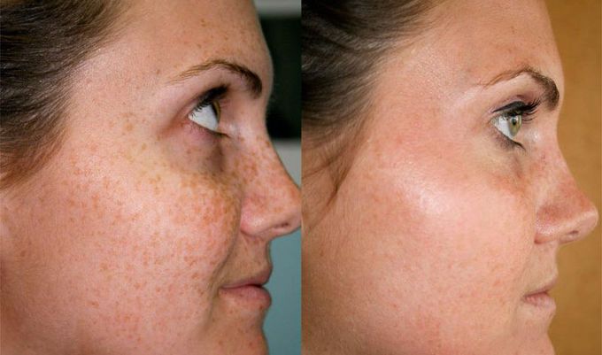 What's the name of this cutaneous sign??