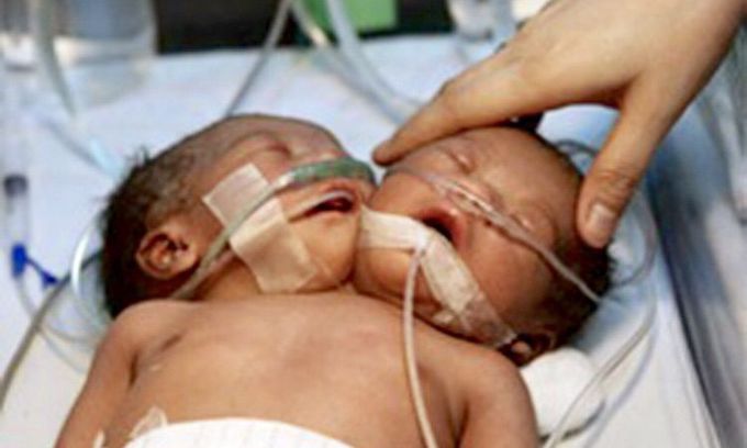 Baby with 2 heads