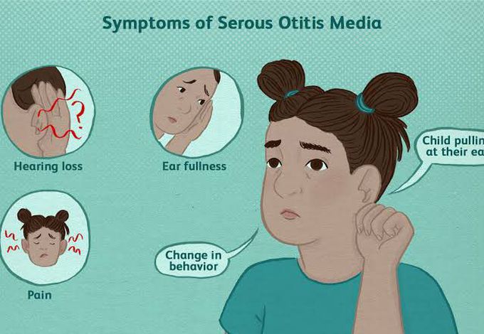 Otitis media