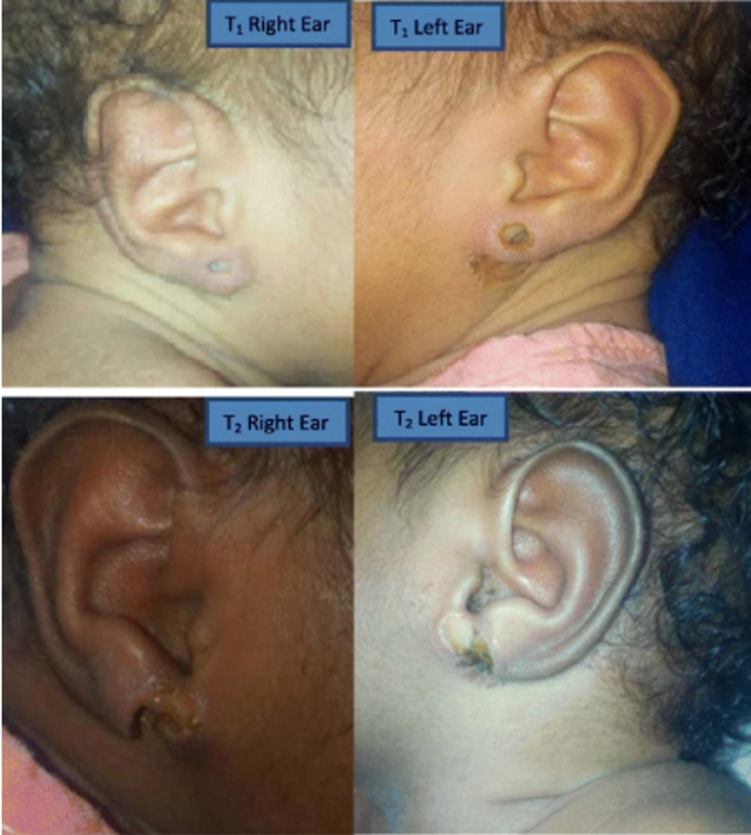 Necrotizing Soft Tissue Infection in Twins Secondary to Aseptic Ear Piercing Technique