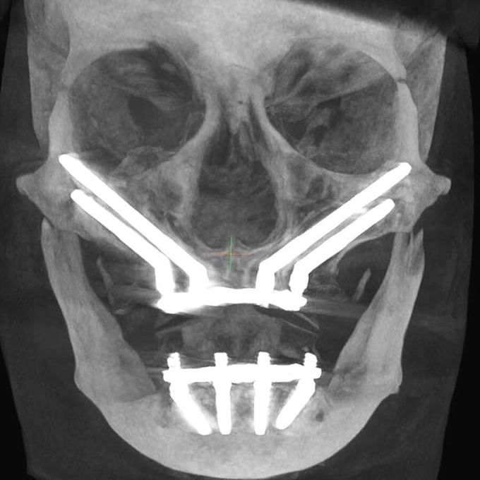 When you've got metals aligned in your mouth that grants you MEDizzy