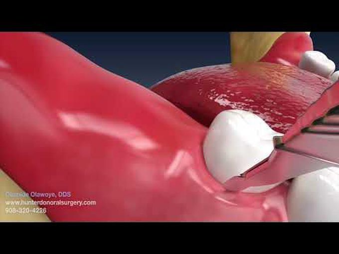 Wisdom teeth removal animation