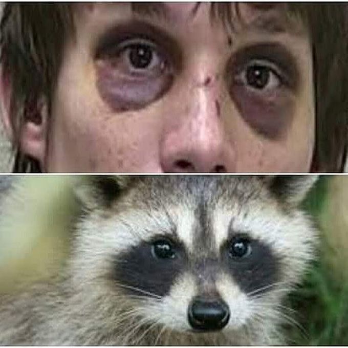 Raccoon eye sign seen in patients with basal skull - MEDizzy