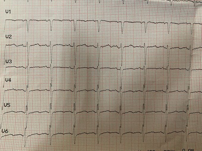 EKG Interpretation