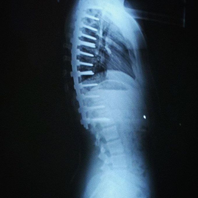 Spinal fusion x-ray