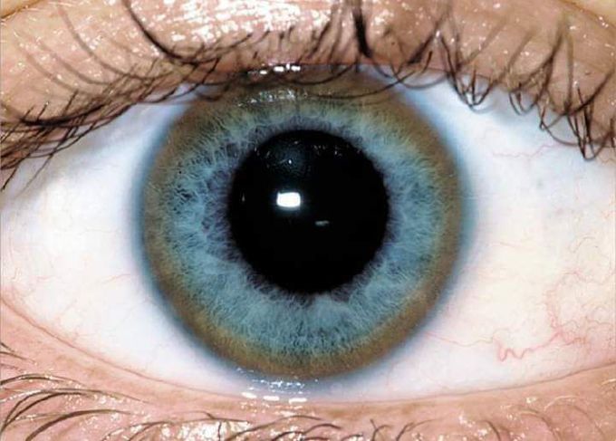 Wilson Disease