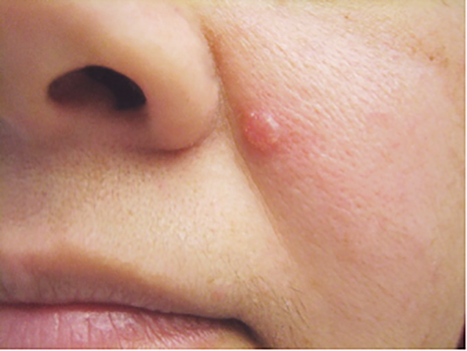 Basal cell carcinoma