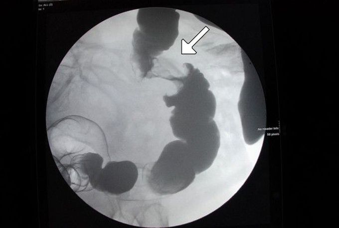 Apple Core Sign in Colorectal Cancer