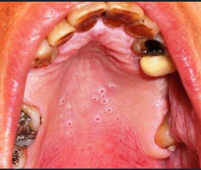 Nicotinic stomatitis