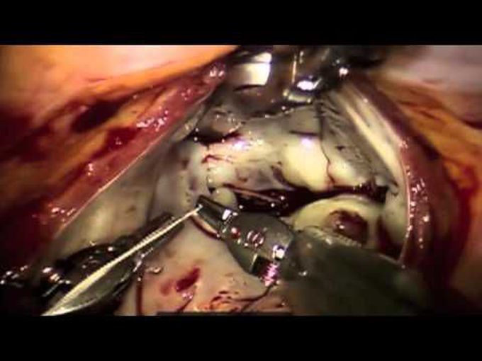 Robotic Repair of Mitral Endocarditis with Preoperative Neurologic Embolic Events