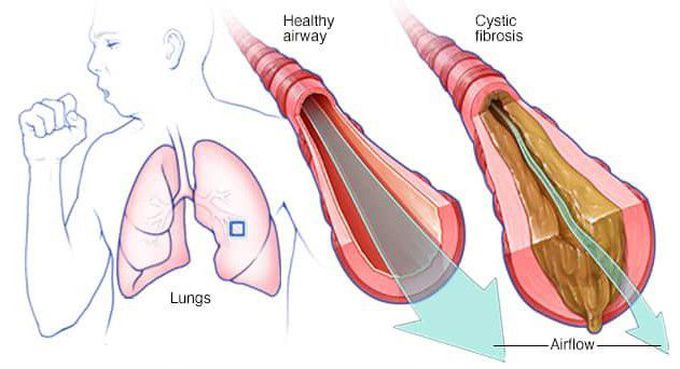 Cause of Cystic fibrosis