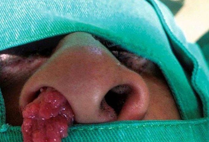 Nasal Rhinosporidiosis