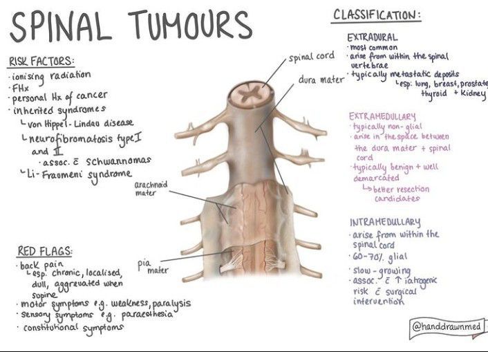 Spinal tumors