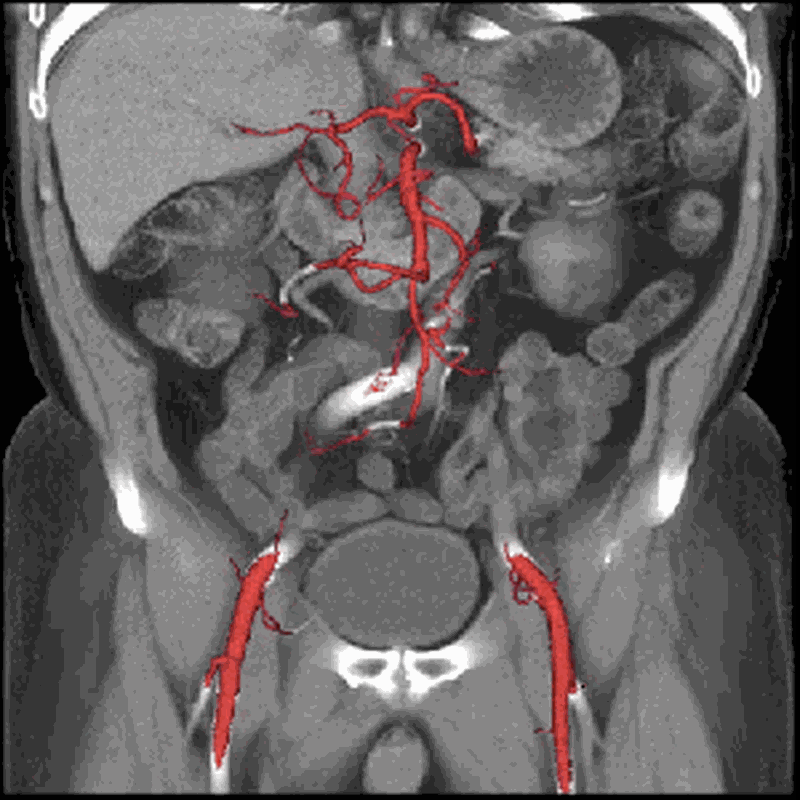 Мрт органов брюшной полости. Кт ангиография чревного ствола. Кт с контрастированием брюшной полости контрастированием органов. Мультиспиральная кт брюшной полости.