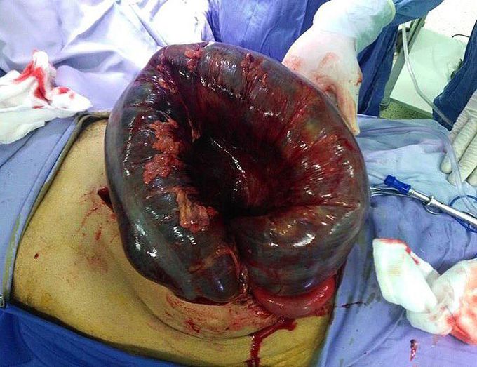 Gangrenous volvulus!! 