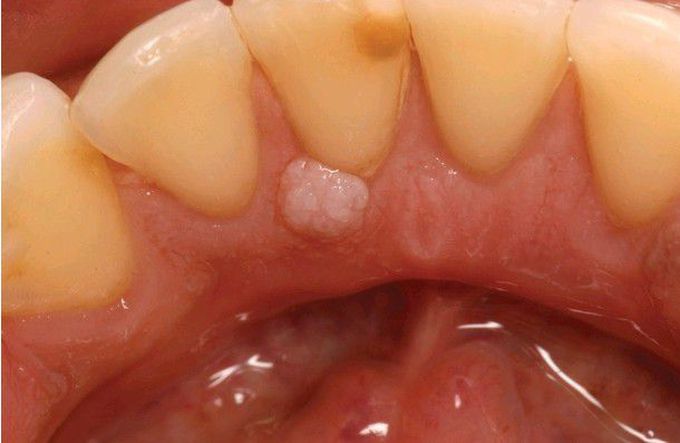 Giant Cell Fibroma