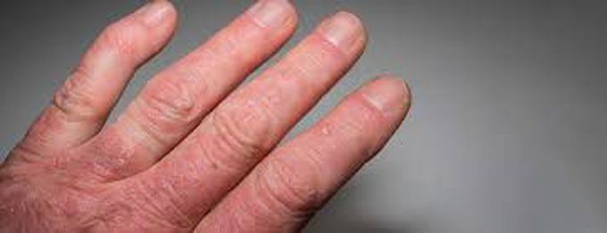 Psoriatic arthritis