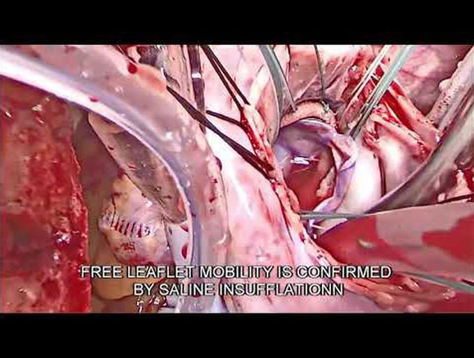 Autopericardial Mitral Valve Reconstruction: How I Do It