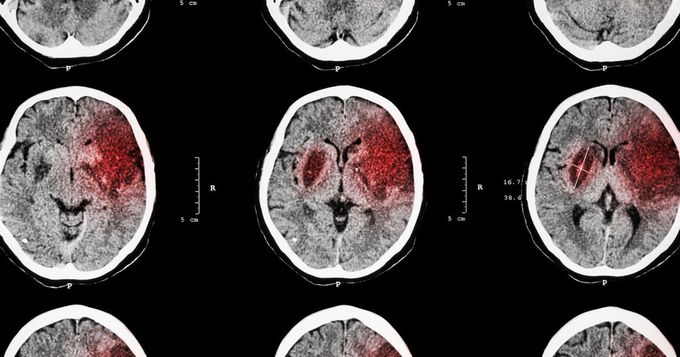 An already-approved drug could help repair the brain after a stroke