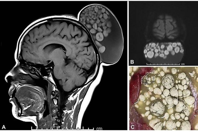 Teratoma