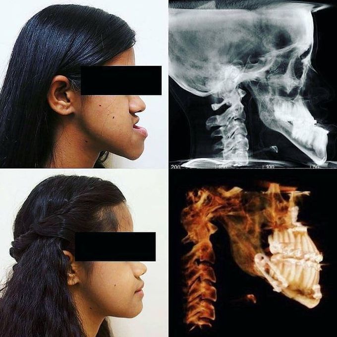 Severe Prognathism Treated well!