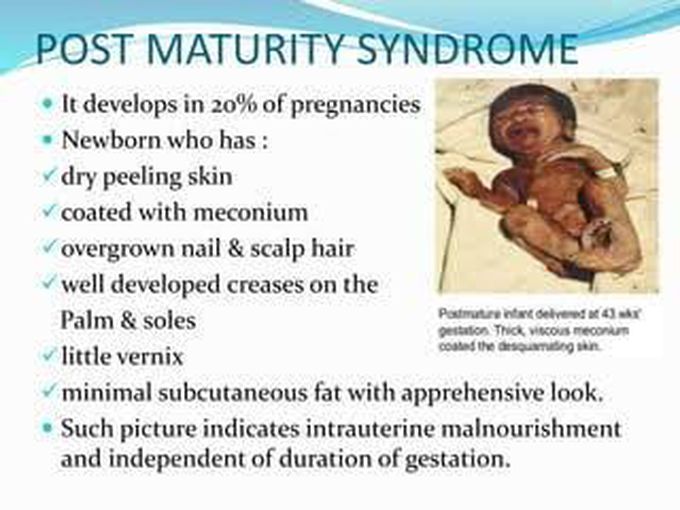 These are the symptoms of Post Maturity syndrome