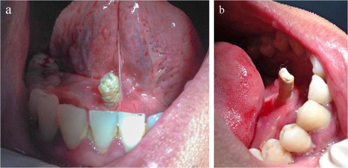 What causes salivary stones?