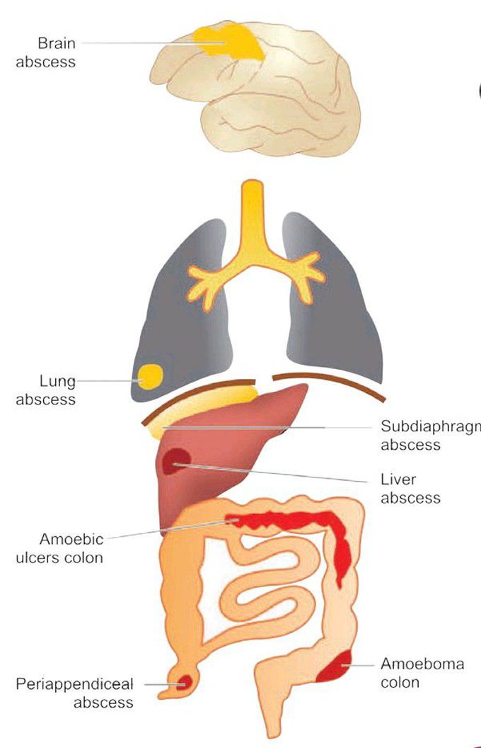 Amoebiasis