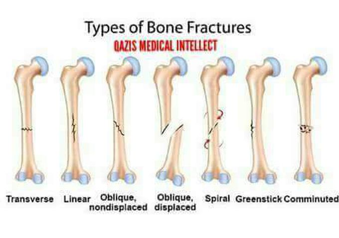 Types of bone fractures.