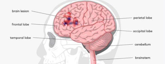 Cause of brain lesion