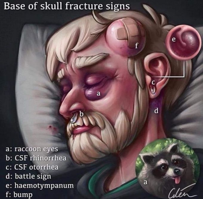 Skull fracture