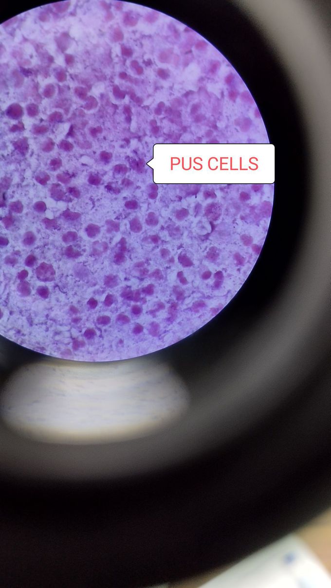 Pus cells