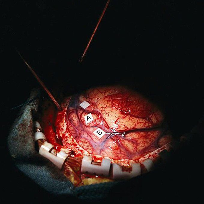 Skillful surgeons remove a tumor from a woman's brain.