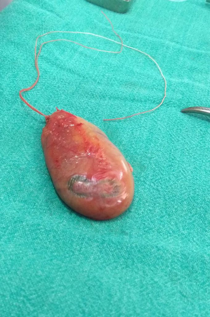 Gallbladder