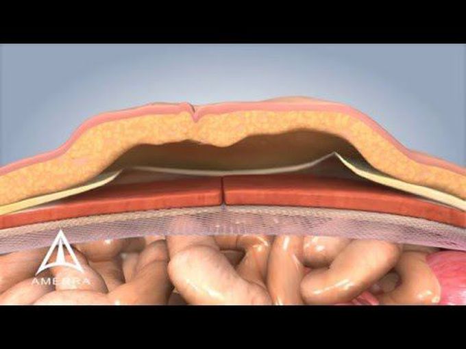 Repair of Ventral Hernia: Animation