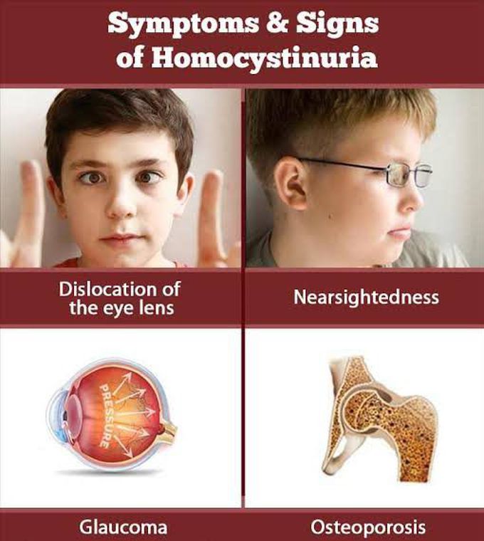 Homocystinuria