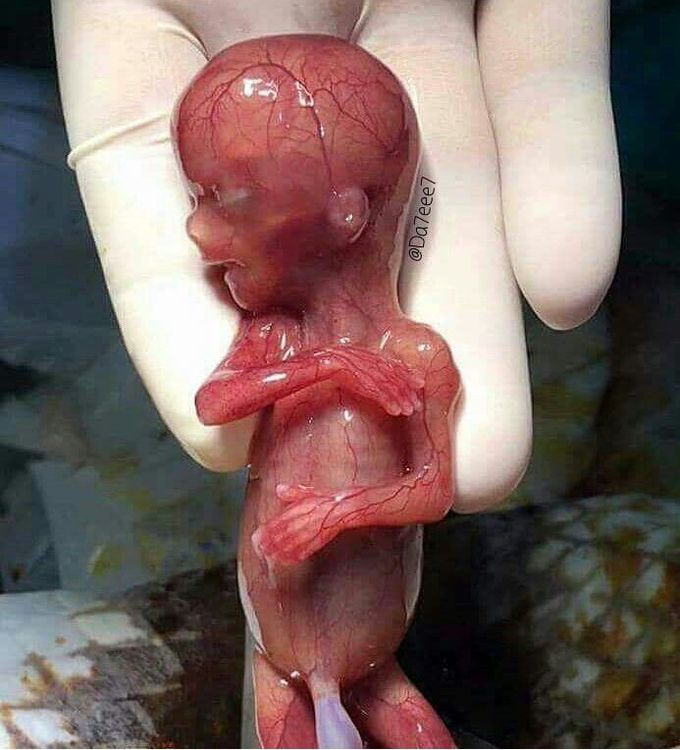Fetus at 18 weeks of gestation