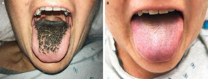 Black Hairy Tongue