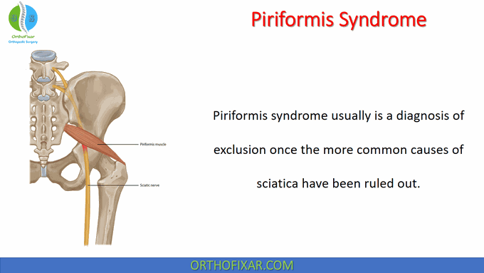 Piriformis Syndrome • Easy Explained - OrthoFixar 2022