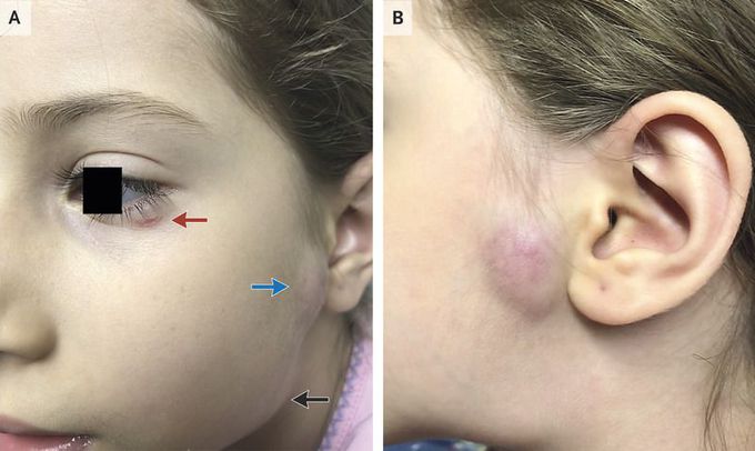 Parinaud’s Oculoglandular Syndrome in Cat Scratch Disease