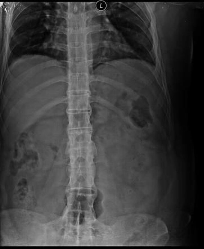 Bamboo Spine on X-ray in a patient with Ankylosing Spondylitis